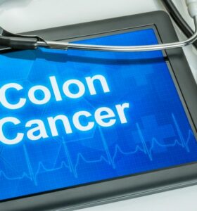 Colon Cancer Diagnosis - Tennessee Cancer Specialists